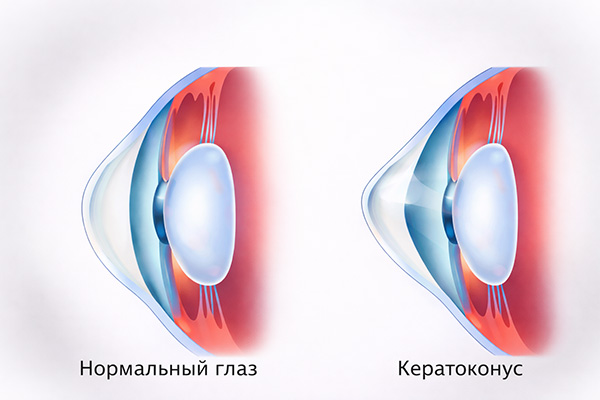 Что такое кератоконус
