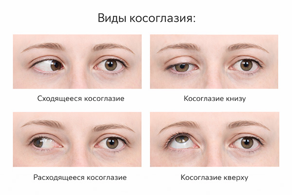 Виды косоглазия