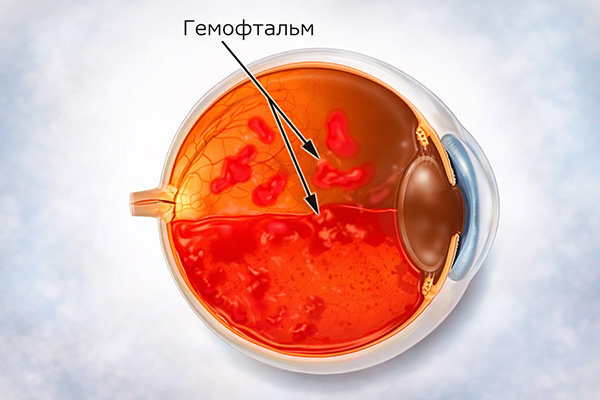 Гемофтальм